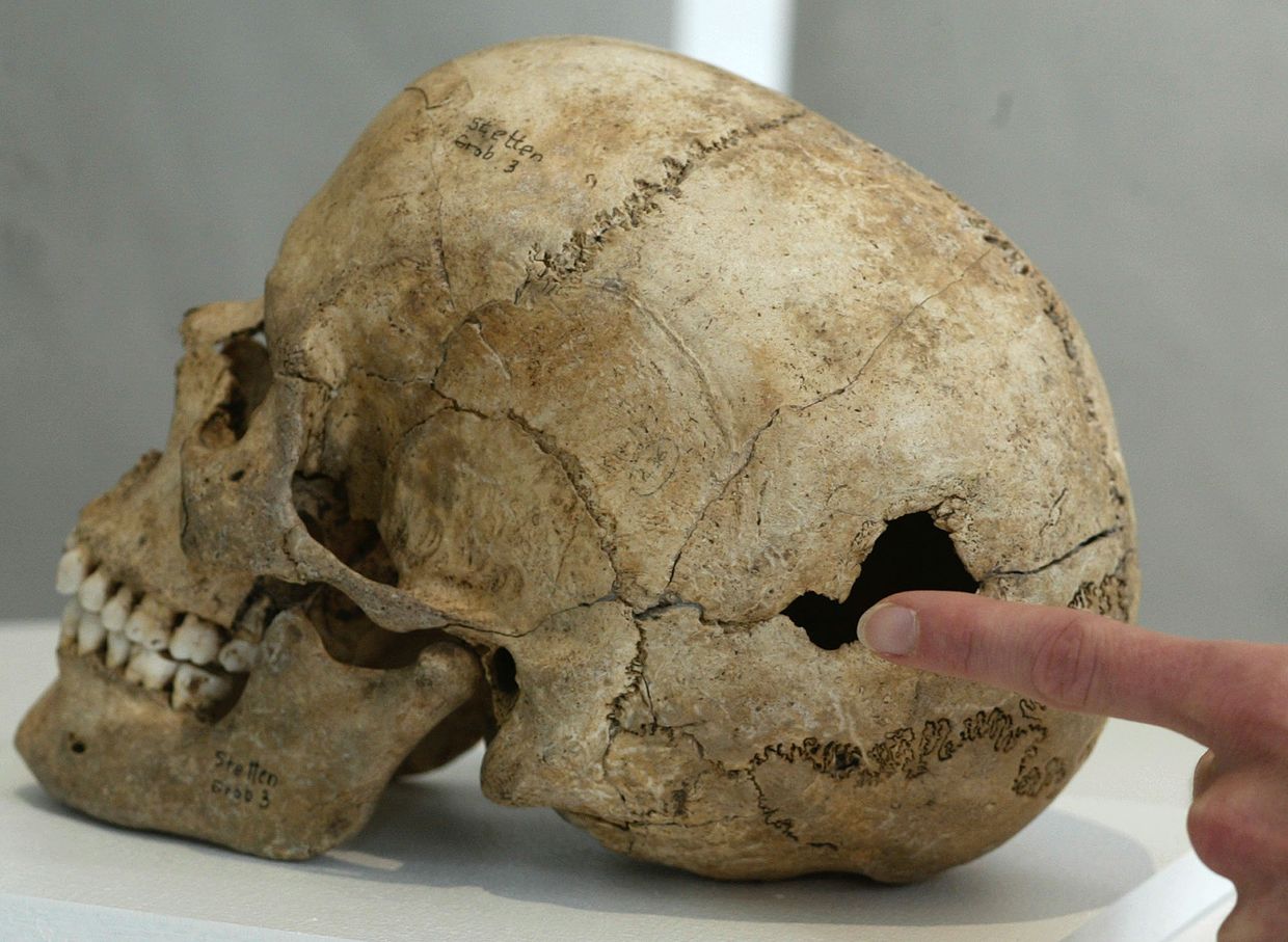 Череп, возрастом 5100 лет со следами трепанации во Фрайбурге