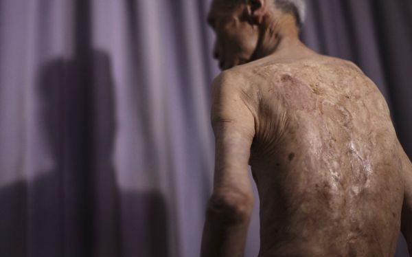 Японец Сумитэру Танигути, выживший после бомбардировки Нагасаки в 1945 году